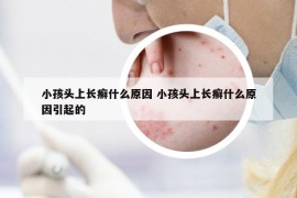 小孩头上长癣什么原因 小孩头上长癣什么原因引起的