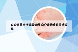 白介素是治疗银屑病吗 白介素治疗银屑病效果