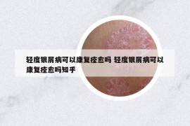 轻度银屑病可以康复痊愈吗 轻度银屑病可以康复痊愈吗知乎