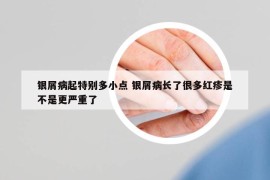 银屑病起特别多小点 银屑病长了很多红疹是不是更严重了