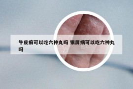 牛皮癣可以吃六神丸吗 银屑病可以吃六神丸吗