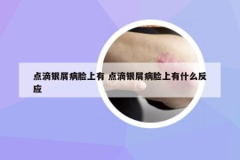 点滴银屑病脸上有 点滴银屑病脸上有什么反应