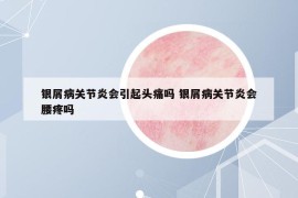 银屑病关节炎会引起头痛吗 银屑病关节炎会腰疼吗