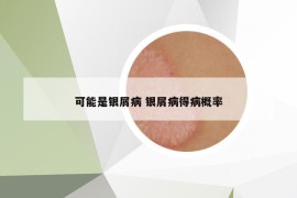 可能是银屑病 银屑病得病概率