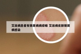 艾滋病患者有银屑病病症嘛 艾滋病皮肤银屑病感染