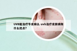 UVB能治疗牛皮癣么 uvb治疗皮肤病有什么优点?