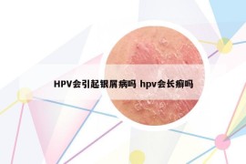 HPV会引起银屑病吗 hpv会长癣吗