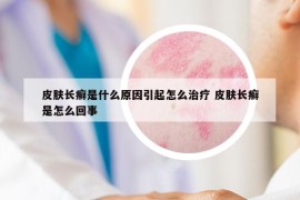 皮肤长癣是什么原因引起怎么治疗 皮肤长癣是怎么回事