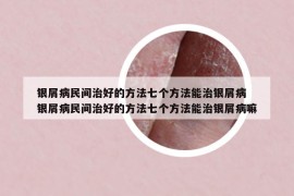 银屑病民间治好的方法七个方法能治银屑病 银屑病民间治好的方法七个方法能治银屑病嘛