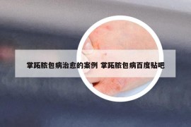 掌跖脓包病治愈的案例 掌跖脓包病百度贴吧