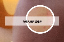 白癜风抹药后痒痒