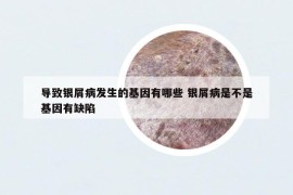 导致银屑病发生的基因有哪些 银屑病是不是基因有缺陷