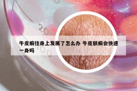 牛皮癣往身上发展了怎么办 牛皮肤癣会快速一身吗