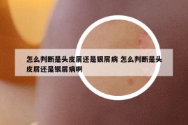 怎么判断是头皮屑还是银屑病 怎么判断是头皮屑还是银屑病啊