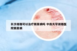 长沙湘雅可以治疗银屑病吗 中南大学湘雅医院银屑病