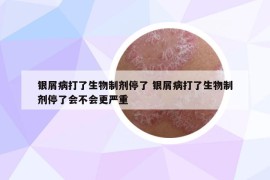 银屑病打了生物制剂停了 银屑病打了生物制剂停了会不会更严重