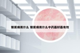 银屑病用什么 银屑病用什么中药最好最有效