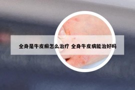 全身是牛皮癣怎么治疗 全身牛皮病能治好吗