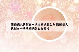 腹透病人头部有一块块癣状怎么办 腹透病人头部有一块块癣状怎么办图片