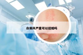 白癜风严重可以结婚吗