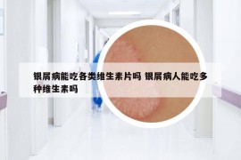 银屑病能吃各类维生素片吗 银屑病人能吃多种维生素吗