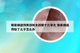 银屑病遗传男孩和女孩那个几率大 银屑病遗传给了儿子怎么办