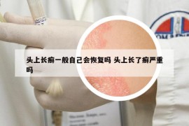 头上长癣一般自己会恢复吗 头上长了癣严重吗