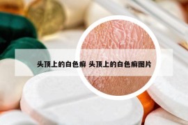 头顶上的白色癣 头顶上的白色癣图片