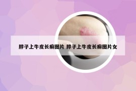 脖子上牛皮长癣图片 脖子上牛皮长癣图片女