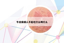 牛皮癣病人不能吃什么喝什么