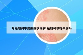 月经期间牛皮癣症状缓解 经期可以吃牛皮吗