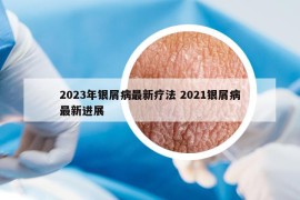 2023年银屑病最新疗法 2021银屑病最新进展