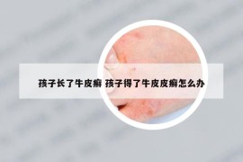 孩子长了牛皮癣 孩子得了牛皮皮癣怎么办