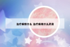 治疗癣擦什么 治疗癣用什么药膏