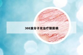 308准分子光治疗银屑病