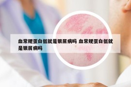 血常规蛋白低就是银屑病吗 血常规蛋白低就是银屑病吗