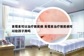 青霉素可以治疗银屑病 青霉素治疗银屑病可以给孩子用吗