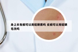 身上长有癣可以用硫磺熏吗 皮癣可以用硫磺皂洗吗