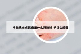 手指头有点起癣用什么药擦好 手指头起藓