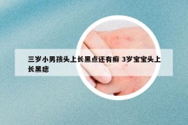 三岁小男孩头上长黑点还有癣 3岁宝宝头上长黑痣