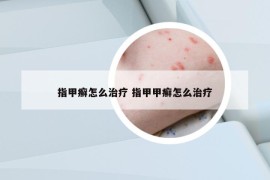 指甲癣怎么治疗 指甲甲癣怎么治疗