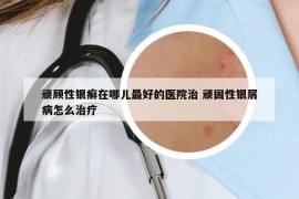 顽顾性银癣在哪儿最好的医院治 顽固性银屑病怎么治疗