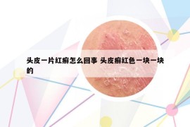 头皮一片红癣怎么回事 头皮癣红色一块一块的