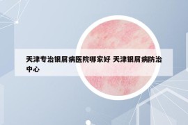 天津专治银屑病医院哪家好 天津银屑病防治中心