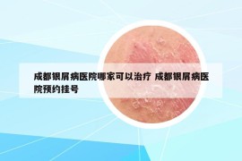 成都银屑病医院哪家可以治疗 成都银屑病医院预约挂号