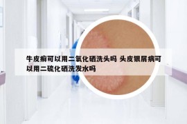 牛皮癣可以用二氧化硒洗头吗 头皮银屑病可以用二硫化硒洗发水吗