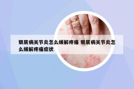 银屑病关节炎怎么缓解疼痛 银屑病关节炎怎么缓解疼痛症状