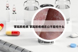 掌跖脓疱病 掌跖脓疱病忌口不能吃什么