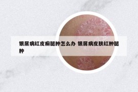 银屑病红皮癣腿肿怎么办 银屑病皮肤红肿腿肿