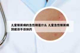 儿童银屑病的急性期是什么 儿童急性银屑病到底该不该抹药